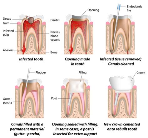 Root Canal: A Complete Guide to Treatment and Procedures