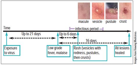 Adult Chicken Pox Symptoms And Treatment For The Virus