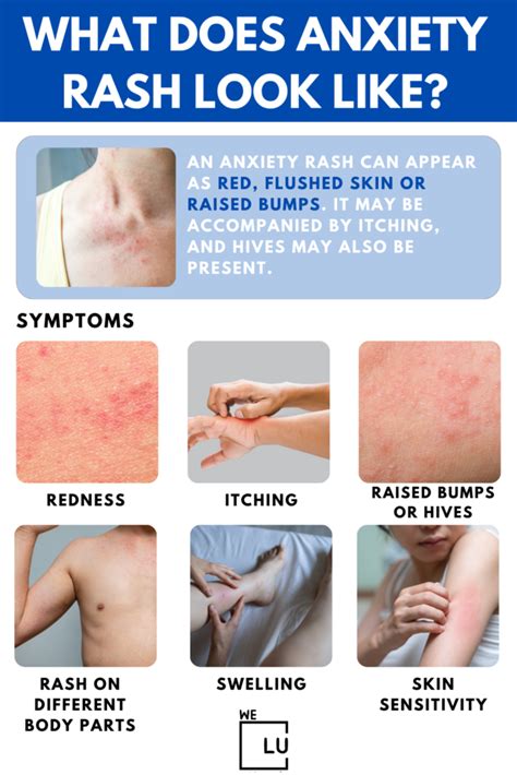 Anxiety Rash Symptoms, Causes, Treatment, And Prevention