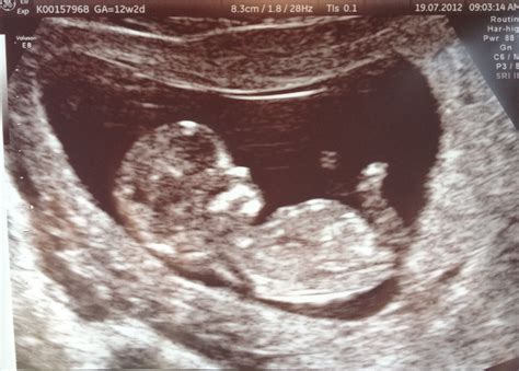 Semi-urban Mom: Diary of a Real Pregnancy - Week 12: The Proof in the Ultrasound Pudding