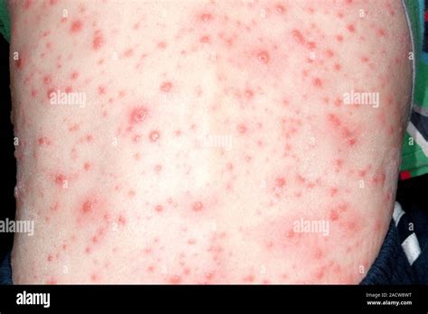 Chicken pox. Close-up of chicken pox rash on the skin of a 3-year-old ...