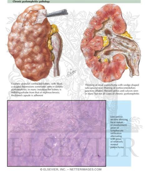 Pyelonephritis - Chronic Pyelonephritis: Pathology