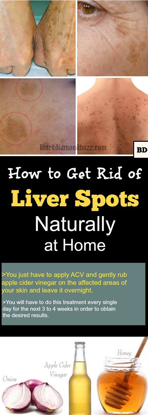 11 Best Way on How to Get Rid of Liver Spots Naturally at Home