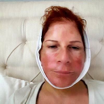 Lower Face And Neck Lift Recovery Photos (4) » Facelift: Info, Prices, Photos, Reviews, Q&A