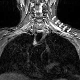 Brachial plexus MRI, contrast media enhancement was shown at left... | Download Scientific Diagram