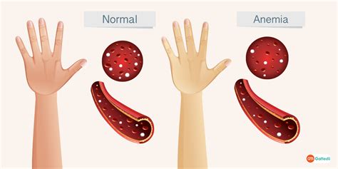 Iron Deficiency Anemia Symptoms