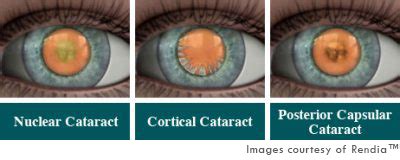 How to diagnose and grade cataracts - EyeGuru