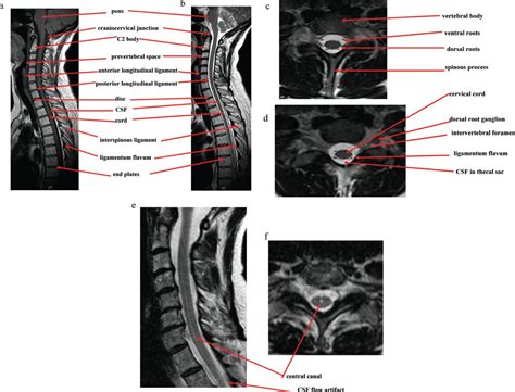 Lumbar Spine Mri Labeled