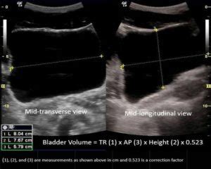 Introduction to Point of Care Urinary Bladder Ultrasound | Point-of-Care Ultrasound ...