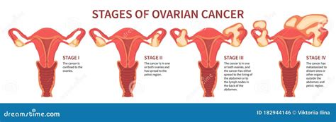 √ Belly Stage 4 Ovarian Cancer Bloating Pictures : Belly Bloat Why Your Hormones Might Be The ...