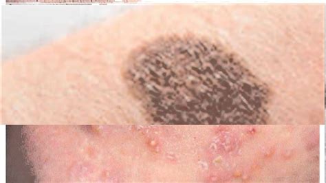 Types Of Skin Diseases - Skin Conditions : Acne, Eczema, Psoriasis, Skin Cancer ... - Diseases ...