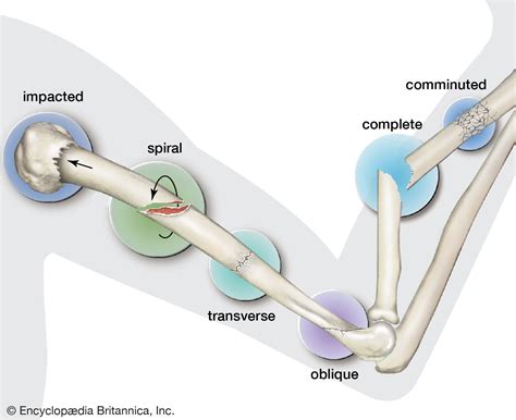 Fracture | Types, Causes & Symptoms | Britannica