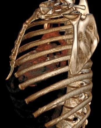 Xiphoid Process Pain Lump On The Sternum Structure