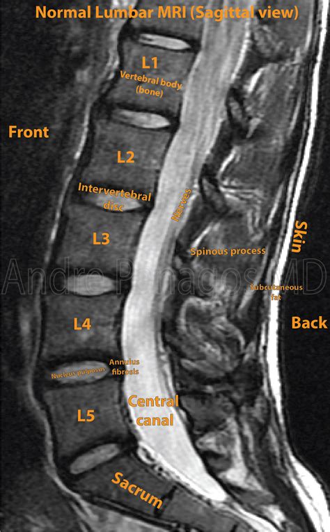 Mri Lumbar Spine Sagittal Cross Sectional Anatomy Anatomy Images Mri | The Best Porn Website