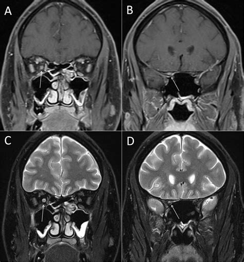 Gd enhancement and T2 lesion of the right optic nerve. Optic nerve MR... | Download Scientific ...