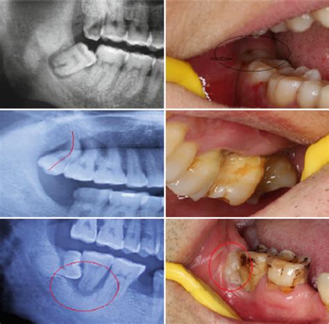 Wisdom Teeth Function – Boston Dentist – Congress Dental Group 160 ...