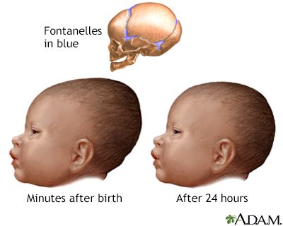 Newborn head molding Information | Mount Sinai - New York