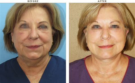 Mid Face Lift – Before and After Pictures * – Dr Turowski – Plastic Surgery Chicago