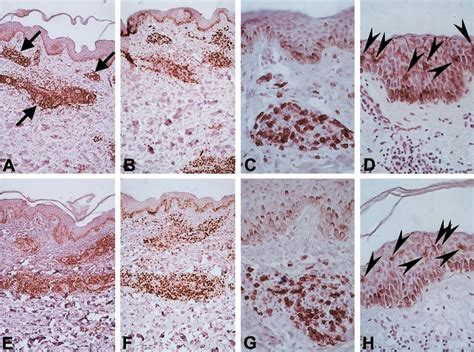 Figure 1 from Local nerve damage in leprosy does not lead to an impaired cellular immune ...