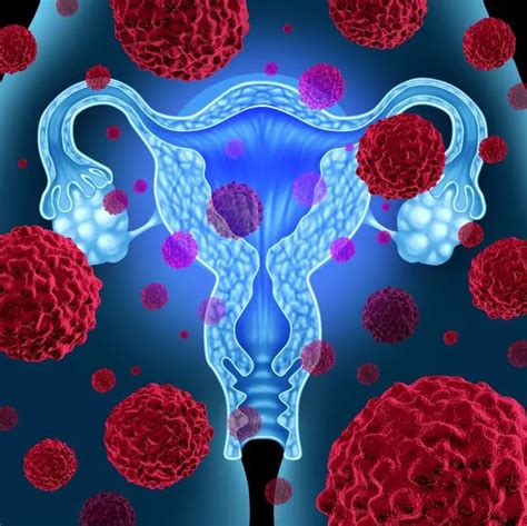 Cervical intraepithelial neoplasia: symptoms, grades, diagnosis, treatment | Women's he alth 2024