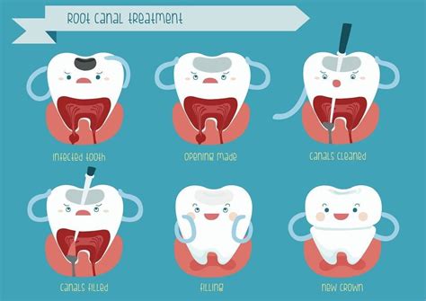 Root Canal Treatment Auckland NZ | Stanmore Bay Dental Studio