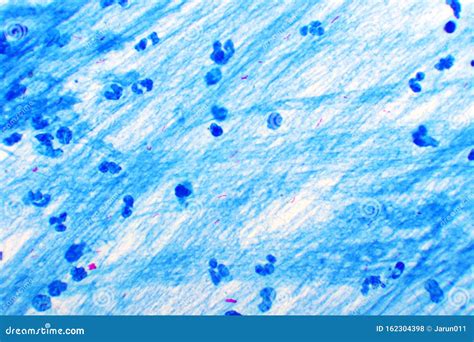 Acid-fast Bacilli. Ziehl Neelsen Stain Stock Photo | CartoonDealer.com ...