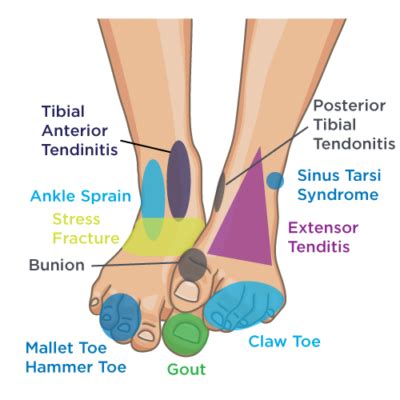 Pinpoint Your Foot & Ankle Pain | OrthoNebraska