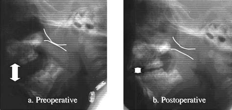 FIG. Preoperativeaand postoperativebphotos of the adenoid.... | Download Scientific Diagram