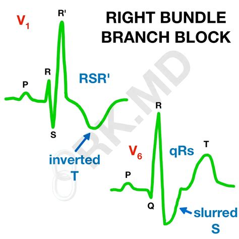 Left Bundle Branch Block Ecg