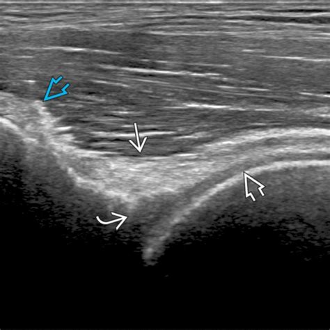 Hip Ultrasound | Radiology Key