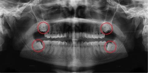 What are wisdom teeth, and should you have them removed?