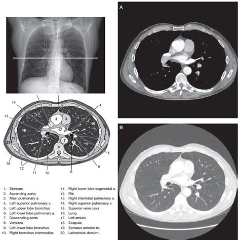 Chest CT Scan Imaging - RadTechOnDuty | Ct scan, Medical radiography ...