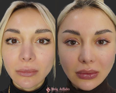 Russian Lip Filler Before & After Results - Skinly Aesthetics