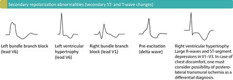 The T-wave: physiology, variants and ECG features