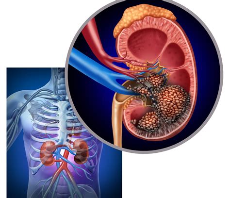 * An Overview of Kidney Cancer - symptoms, causes and treatment alternatives | CANCERactive