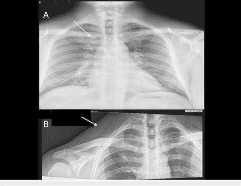 Chest X-ray AP view and right clavicle X-ray AP view. A: Chest X-ray AP... | Download Scientific ...