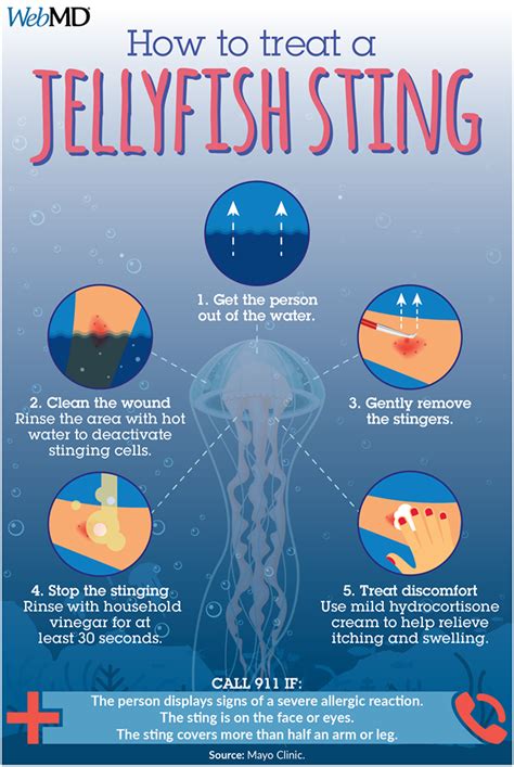 Box jellyfish sting,what to know?