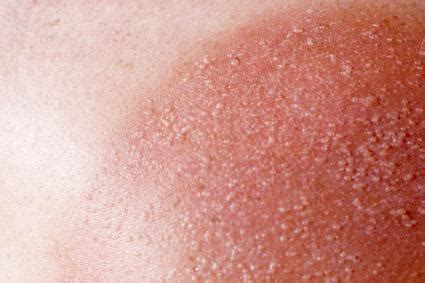 Sun Poisoning Rash | LoveToKnow