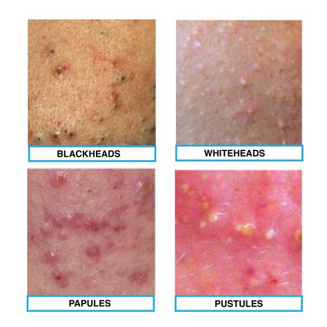 The four types of acne: blackheads, whiteheads, papule and pustules. Remember if you have any ...