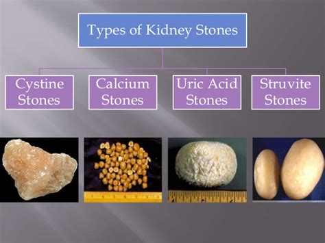 Kidney Stones Symptoms & Kidney Stone Treatment: What You Need to Know