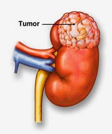 Brady Urology at Johns Hopkins Hospital: Oncocytoma: A Benign Kidney Tumor Often Confused for Cancer