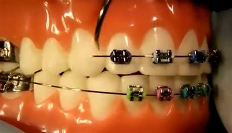 Fixing Broken Braces – Metal, Ceramic and Invisalign Trays