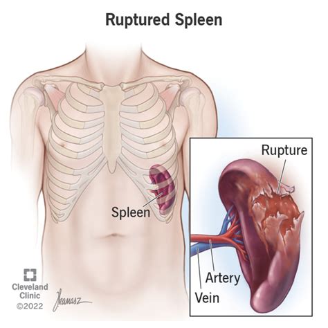 Enlarged Spleen (Splenomegaly): Symptoms, Causes Treatment, 44% OFF