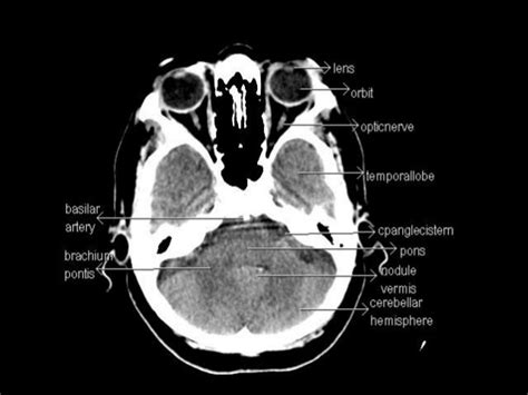 CT Anatomy