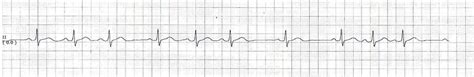 ECG Channel: Sinoatrial Block or Sinoatrial Exit Block