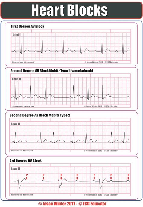 Heart Block Ecg Ppt at Susan Ward blog