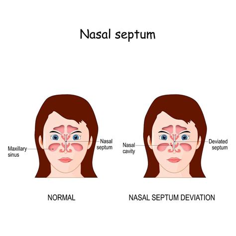 Deviated Septum Diagram