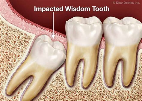 Wisdom Teeth - Coming of Age May Come With a Dilemma