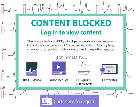 Sinoatrial block (SA block): ECG criteria, causes and clinical features ...