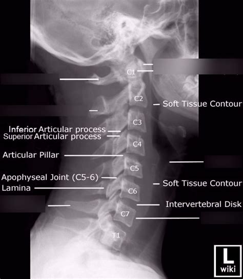 LAT Soft Tissue Neck X-Ray Anatomy Diagram | Quizlet